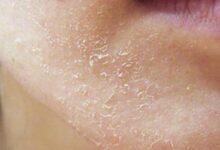 التخلص من جفاف الوجه